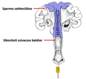 Hagyományos megtermékenyítés