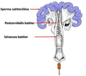 Posztcervikális megtermékenyítés